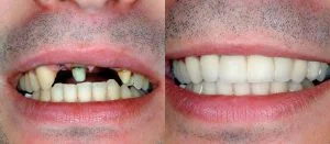 Cosmetic dentistry Sugar Land - Porcelain Veneers