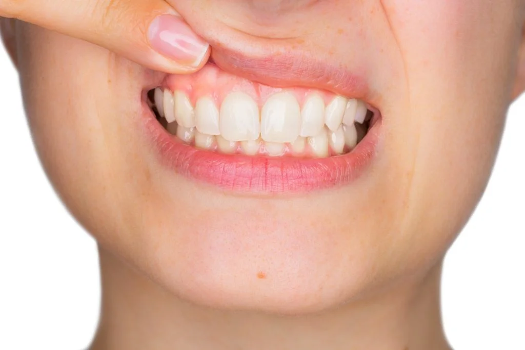 Receding Gums_Dentist in Sugarland TX 1000px
