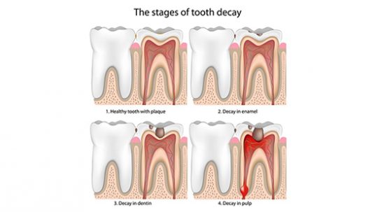 Why Does My Tooth Hurt? Part 1: Tooth Decay | Imperial ...