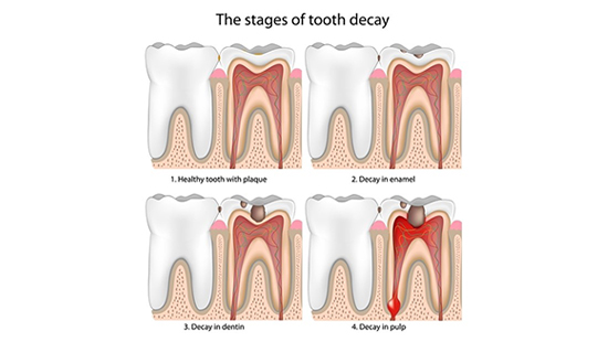 why-does-my-tooth-hurt-part-1-tooth-decay-imperial-dental-center